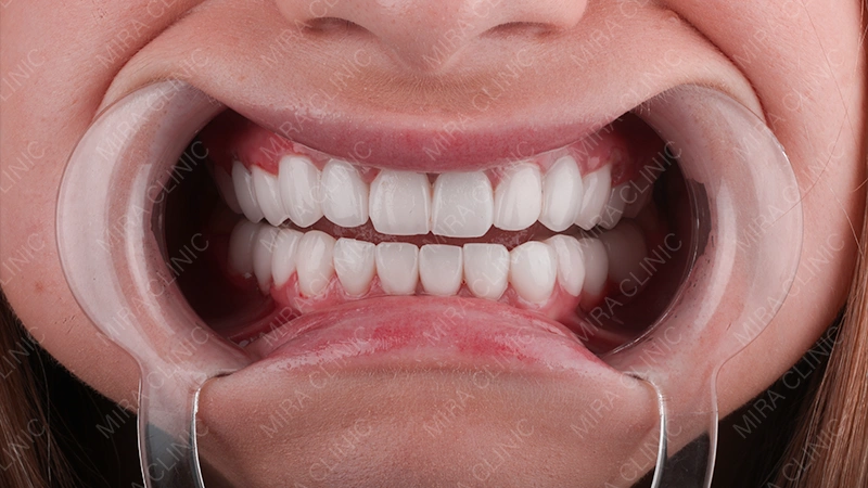 Hollywood smile after placement